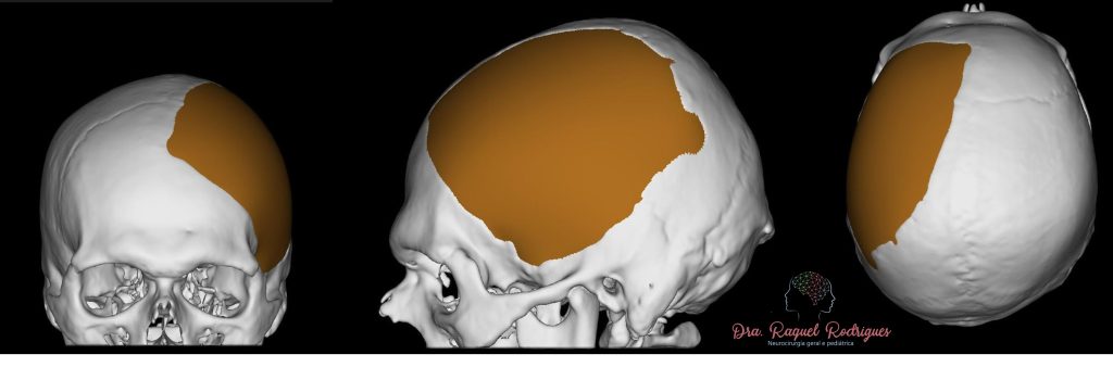 Planejamento computadorizado de uma prótese sintética customizada de crânio para cirurgia de cranioplastia. O software simula a prótese antes de sua produção para aprovação do neurocirurgião a partir da falha óssea da tomografia de crânio do paciente. Cada prótese tem um molde exclusivo. Foto de arquivo pessoal - reprodução total ou parcial proibida.