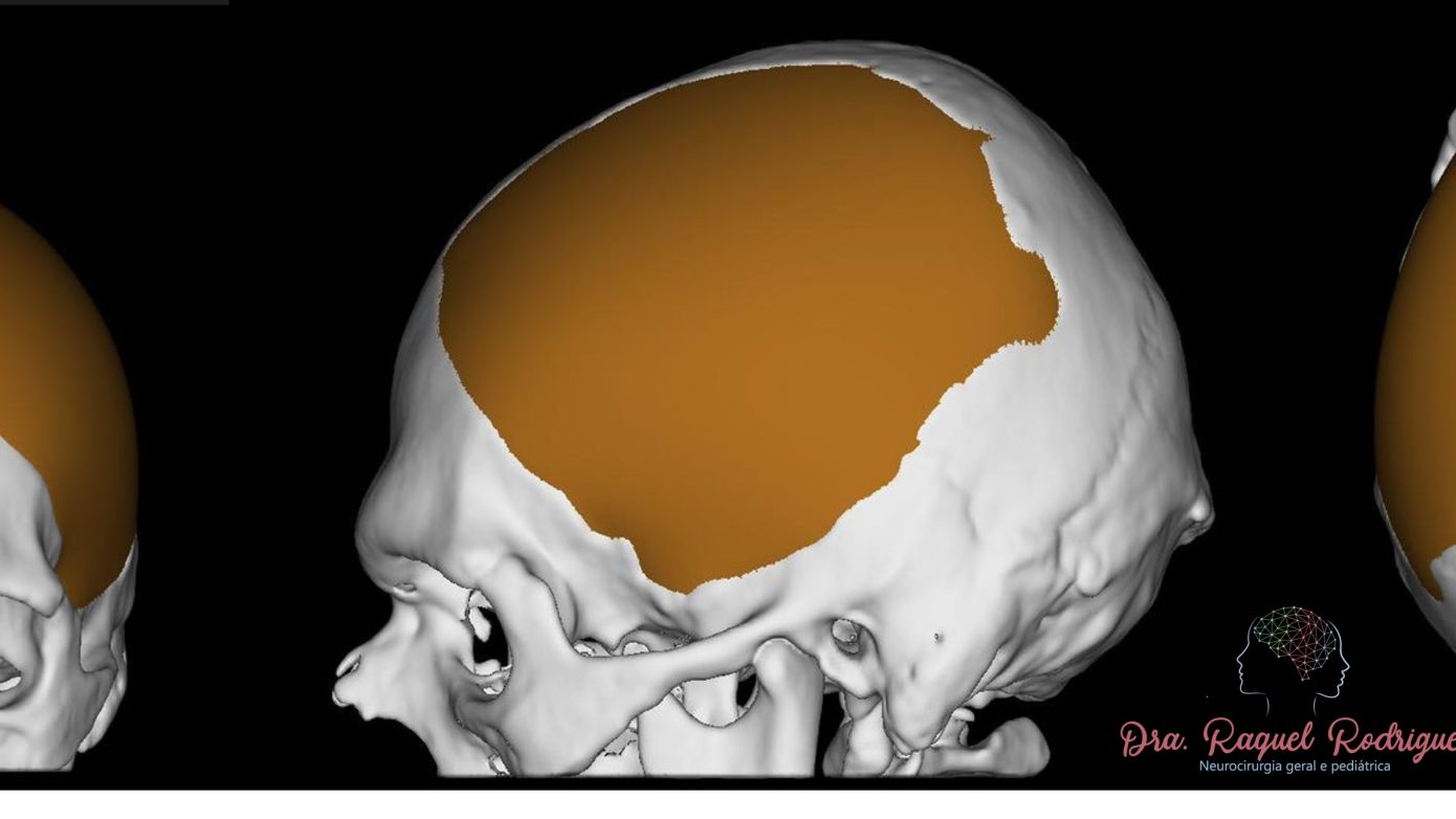 Planejamento computadorizado de uma prótese sintética customizada de crânio para cirurgia de cranioplastia. O software simula a prótese antes de sua produção para aprovação do neurocirurgião a partir da falha óssea da tomografia de crânio do paciente. Cada prótese tem um molde exclusivo. Foto de arquivo pessoal - reprodução total ou parcial proibida.